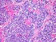 Microscopic Image of a Neuroblastoma Malignant Tumor of the Adrenal Gland Viewed at 300x Magnification with Hematoxylin and Eosin Staining. One of the most Common Cancers Affecting Children.