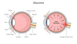 anatomy of a human eye with glaucoma, highlighting increased pressure and optic nerve damage structure diagram hand drawn schematic raster illustration. Medical science educational illustration