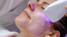A Patient With Severe Rosacea Undergoing Intense Pulsed Light IPL Therapy. The Targeted Light Heats And Destroys The Visible Vessels Causing Redness And Flushing In The Skin.