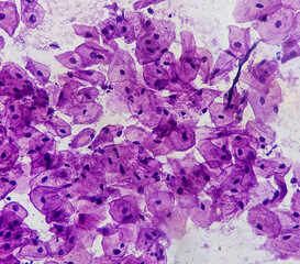 Canvas Print - Light micrograph of a vaginal smear showing adenocarcinoma cells (center). Vaginal cancer. Inflammatory smear with HPV related changes. Cervical cancer. SCC.