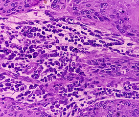 Sticker - Tissue from axilla (biopsy). Invasive squamous cell carcinoma. Smear show skin, invasive squamous cell carcinoma. Skin cancer.