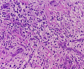 Poster - Tissue from axilla (biopsy). Invasive squamous cell carcinoma. Smear show skin, invasive squamous cell carcinoma. Skin cancer.