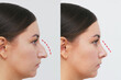 profile of woman's face with nose before and after rhinoplasty isolated on a white background. The result of cosmetic plastic surgery on the nose