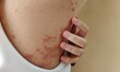 © Rung Kh - close up the fingers scratching the rash hives allergy and inflammation skin, eczema and psoriasis on the back of the woman, health care and medical concept.