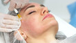 © wedmoments.stock - Medical cosmetology of plasma injections. Cosmetology, facial injections close-up. A professional cosmetologist, doctor does mesotherapy, plasma therapy to a young woman.