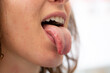 © Alessandro Grandini - woman's tongue displaying potential symptoms of health condition