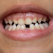 Child's Mouth with Missing Baby Tooth
