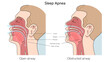 Sleep apnea structure diagram hand drawn schematic vector illustration. Medical science educational illustration