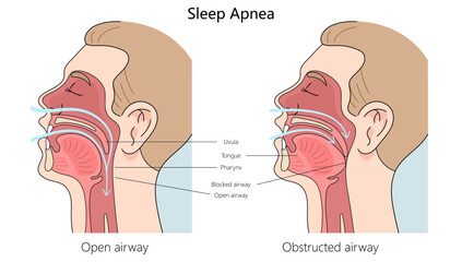 Wall Mural - Sleep apnea structure diagram hand drawn schematic vector illustration. Medical science educational illustration