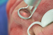 © Tomasz - Laseroterapia w medycynie. Odmładzanie, regeneracja skóry, usuwanie blizn.