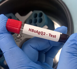 Wall Mural - Blood sample for HBsAgQ2 Test, quantitative determination of hepatitis B surface antigen.