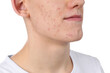 © New Africa - Young man with acne problem isolated on white, closeup