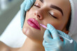 Beautician is contouring the woman's lips with hyaluronic acid filler