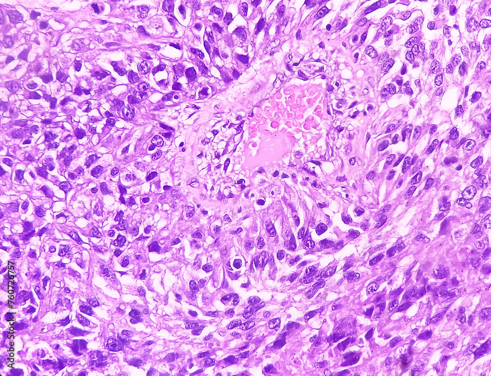 Kidney cancer: Microscopic image of metastatic clear cell carcinoma of ...