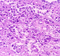 Sticker - Kidney cancer: Microscopic image of metastatic clear cell carcinoma of kidney, the most common type of renal cell carcinoma. Show brain tissue of malignant neoplasm, large atypical bizarre cells.