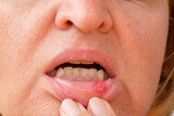 Fototapeta Tulipany - stomatitis in mouth closeup, close-up on the lip with aphthous stomatitis, treatment of inflammation of the oral mucosa