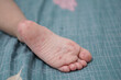 © thebaikers - close up view of child's feet infected with hand feet and mouth disease or HFMD originating from enterovirus or coxsackie virus, zoom shot.