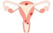 © TKM - Diagrammatic illustration of cervical cancer, anatomy of the uterus and ovaries