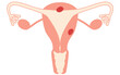 © TKM - Illustrative illustrations of Endometrial cancer, anatomy of the uterus and ovaries