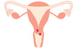 © TKM - Diagrammatic illustration of cervical cancer, anatomy of the uterus and ovaries