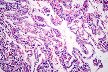 Poster - Smoker's lung, light micrograph