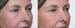 © New Africa - Aging skin changes. Collage with photos of mature woman before and after cosmetic procedure on white background, closeup