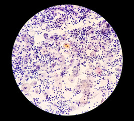 Canvas Print - Paps smear: Inflammatory smear with HPV related changes. Cervical cancer. SCC