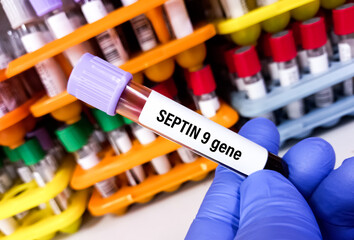 Blood sample for SEPTIN 9 gene (Epi ProColon) test, It's liquid biopsy test for the detection of colorectal cancer.