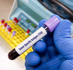 Canvas Print - Blood sample for Tumor specific antigen (TSA) test, tumor-associated antigens.