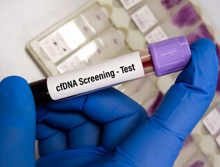 Wall Mural - Blood sample for Prenatal cfDNA (Cell-Free DNA) Screening test for pregnant women. Down syndrome. Disorder of the chromosomes.