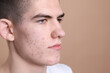© New Africa - Young man with acne problem on beige background, closeup. Space for text