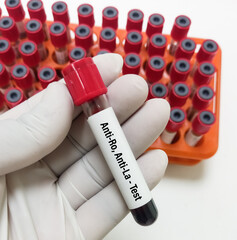 Canvas Print - Blood sample for Sjogren's antibody panel test. Sjogren SSA, SSB. Anti-Ro and Anti-La test.