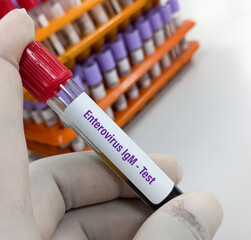 Poster - Blood sample for Enterovirus IgM test to diagnosis of myocarditis. Enterovirus PCR test. Myocarditis disease blood test in doctor hand.