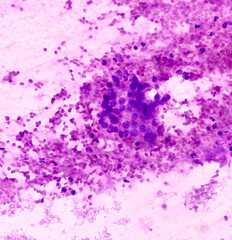 Wall Mural - CT guided FNA from lung lesion, Chronic granulomatous inflammation (CGI) with Tuberculosis. CGI-TB. smear show clusters of epithelioid cells, lymphocytes, histiocytes, giant cells and fibrous tissues.