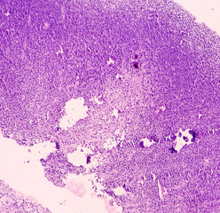 Sticker - Soft tissue sarcoma, plasmacytoma, undifferentiated pleomorphic sarcoma. Microscopically show malignant neoplasm of atypical plasmacytoid cells. plasma cell tumor.