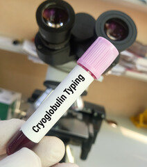 Canvas Print - Blood sample for Cryoglobulin Typing Test.