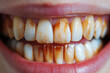 open mouth with unhealthy teeth with yellow plaque and caries close-up