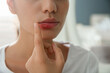 © New Africa - Woman with herpes touching lips against blurred background, closeup