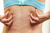 Fototapeta Na sufit - Woman scratching her itchy back with allergy rash