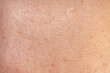 © Artskrin - Skin texture and scar. Close-up stock photo of human skin in best quality.