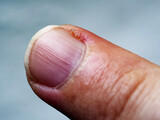 Fototapeta Morze - A human finger with evident signs of minor injury.
