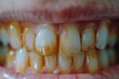 Show the gradual disappearance of yellow plaque from teeth, leaving behind a clean surface