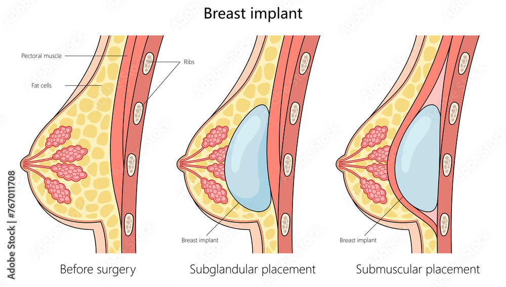 comparison of breast anatomy before surgery and with subglandular and