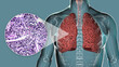 Smoker's lungs, 3D illustration along with a photomicrograph