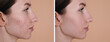 © New Africa - Acne problem. Young woman before and after treatment on beige background, collage of photos