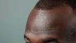 close-up on a black mans head with a receding thinning hairline - concept for hairloss treatment