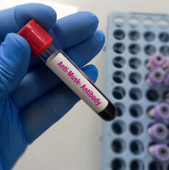 Poster - Blood sample for MuSK(muscle-specific kinase) protein test to diagnosis Myasthenia gravis disease. Autoimmune disease