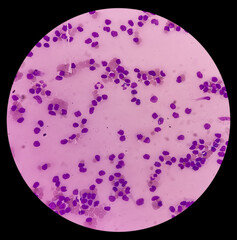 Sticker - Lymphocytosis with Thrombocytopenia. Smear show white blood cells, red blood cells background. Lymphoproliferative disorder.