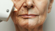 A woman's face is being treated with a laser, with one side of her face being treated and the other side left untreated