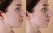 © New Africa - Acne problem. Young woman before and after treatment on beige background, collage of photos